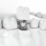 Dental Implants in Cosmetic Dentistry: Beyond Functionality