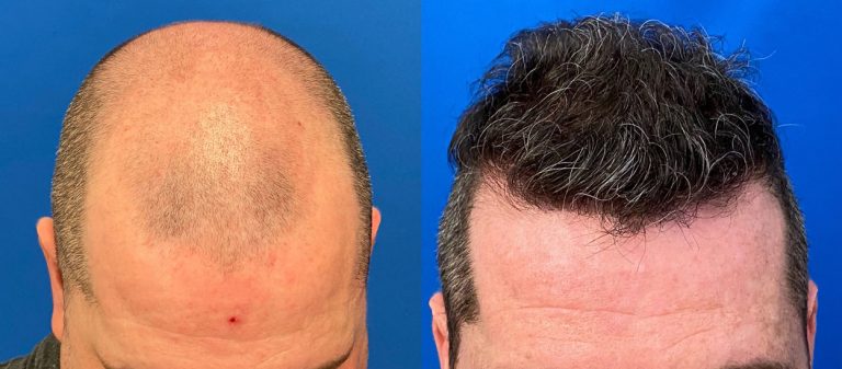 Body-Hair Transplant: A Lifeline for Advanced Norwood Cases
