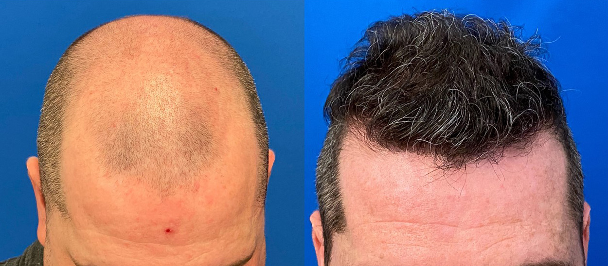 Body-Hair Transplant: A Lifeline for Advanced Norwood Cases