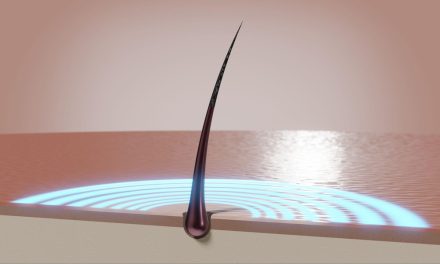 3 Facts About What Permanent Hair Removal Really Means in Clinical Settings